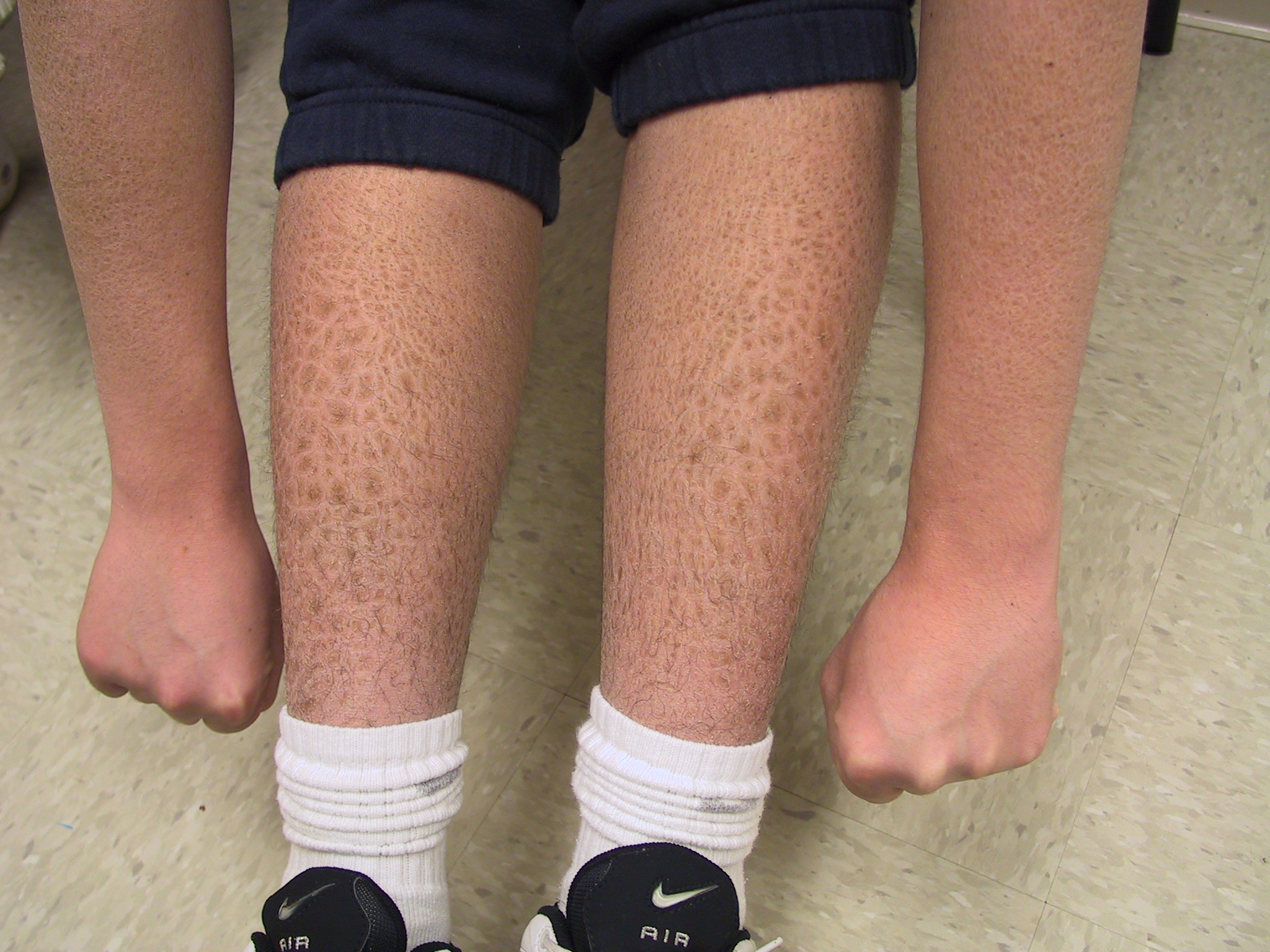 What is X-linked ichthyosis?